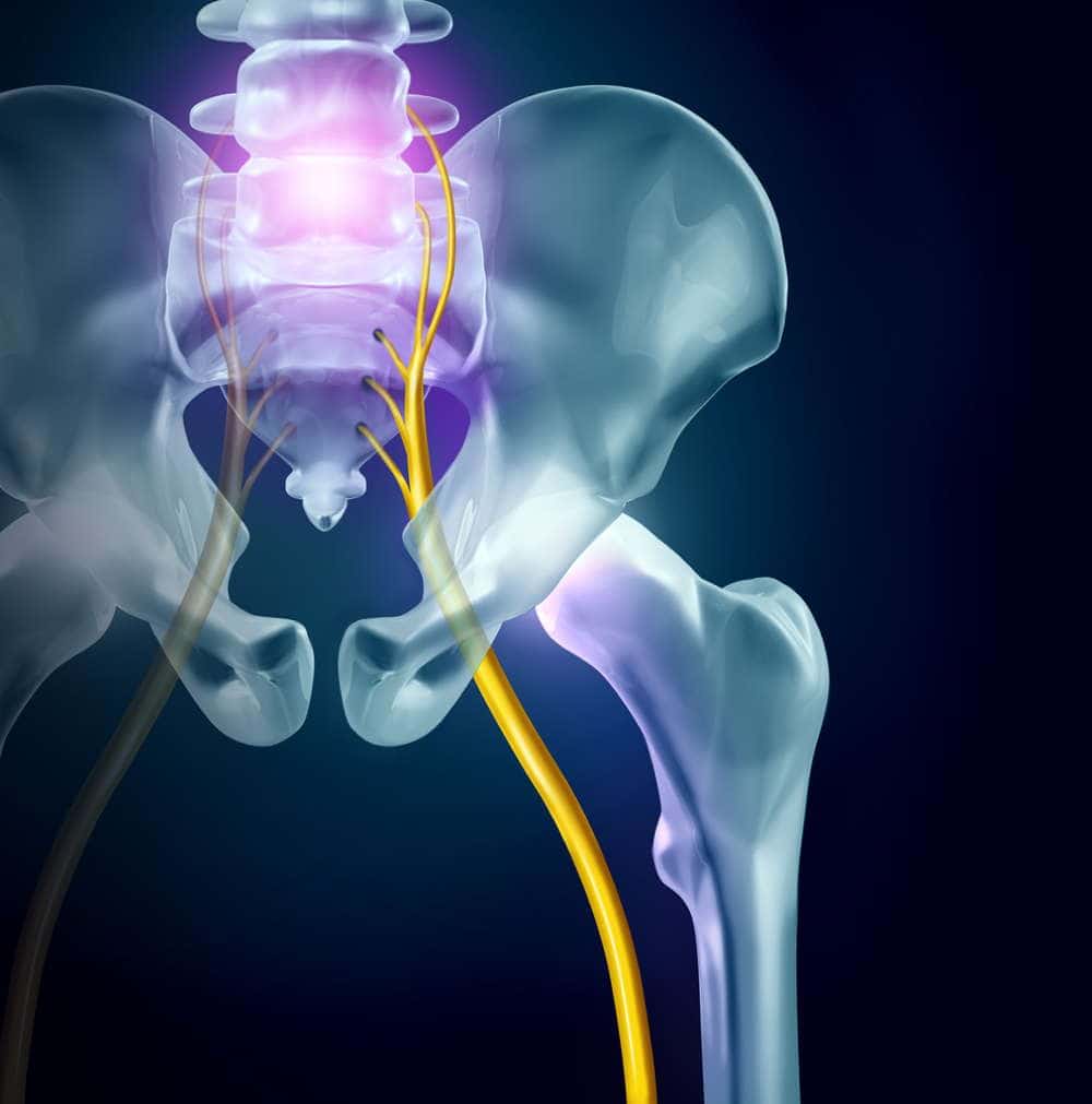 Sciatica pain