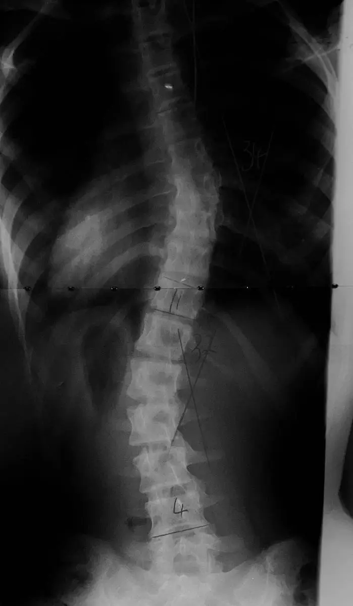 X ray scoliosis