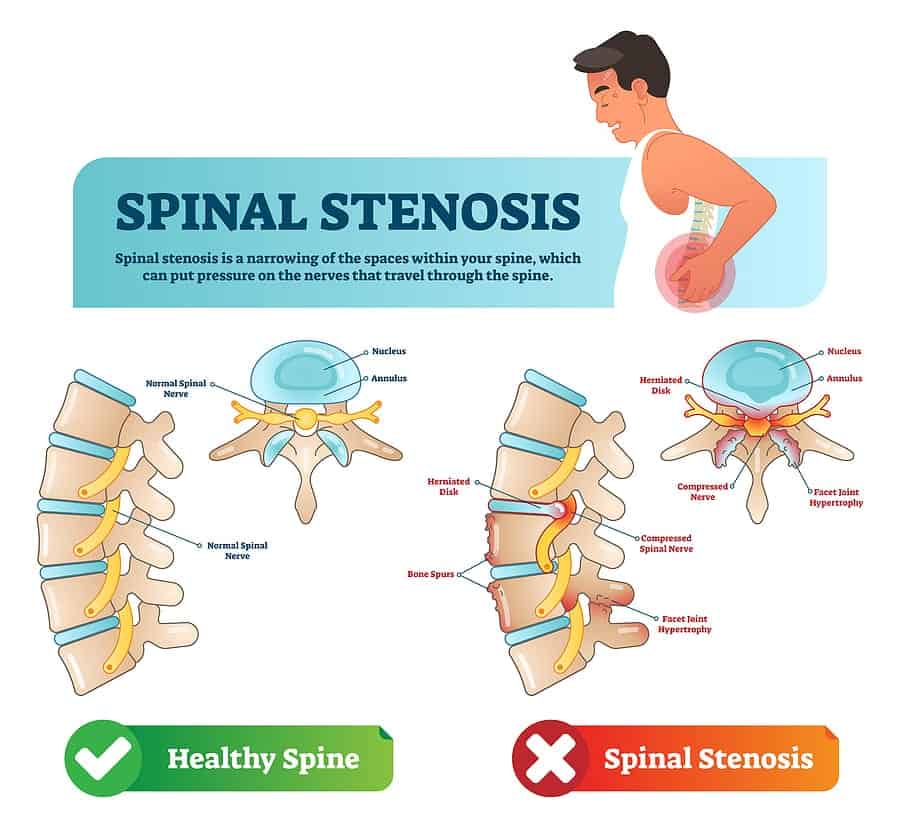 Bigstock Spinal Stenosis Vector Illustr 252456904 1