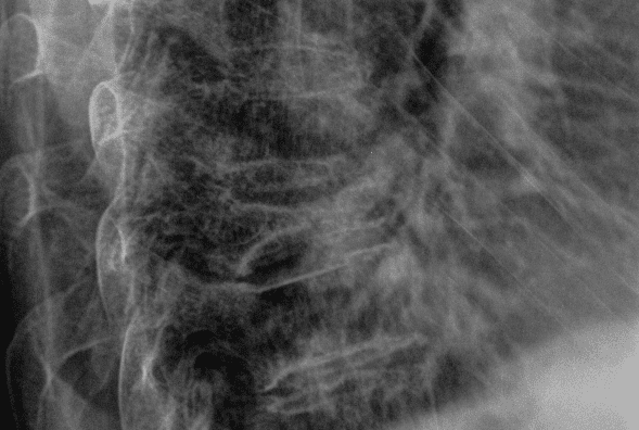 Compression fracture