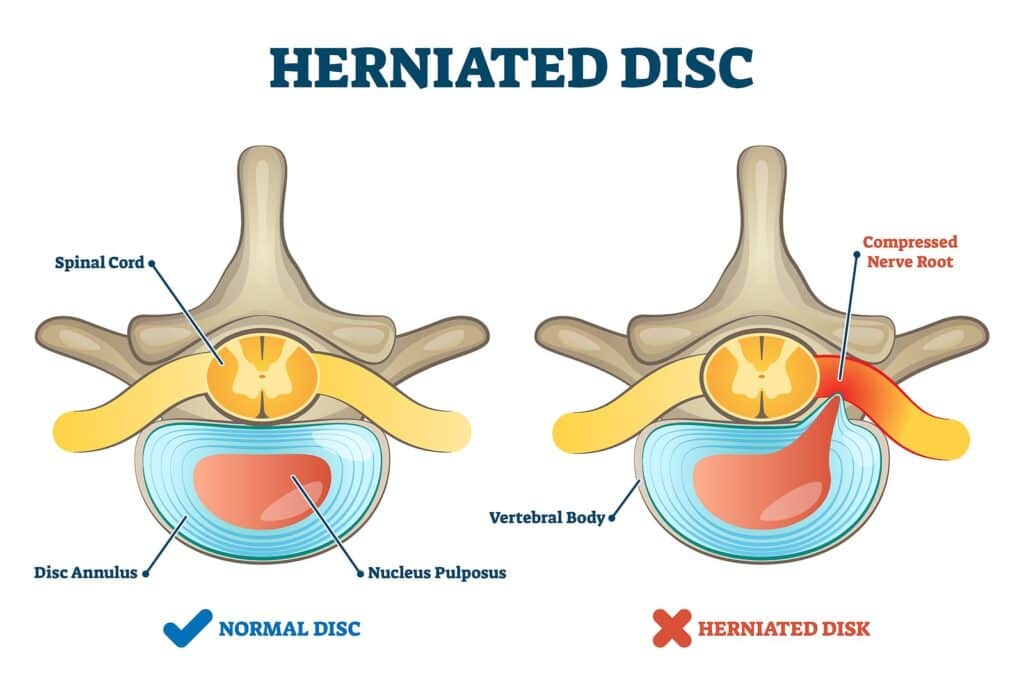 Herniated disc showing annulus amd nucleus pulposus