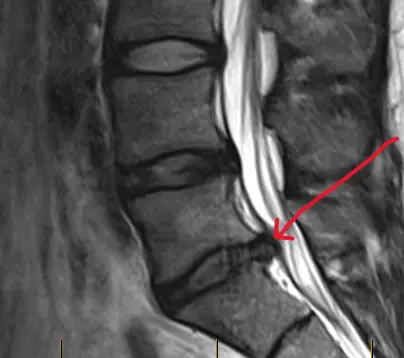 Lumbar disc protrusion