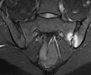 Mri displying inflammatory changes in sacroiliac joint