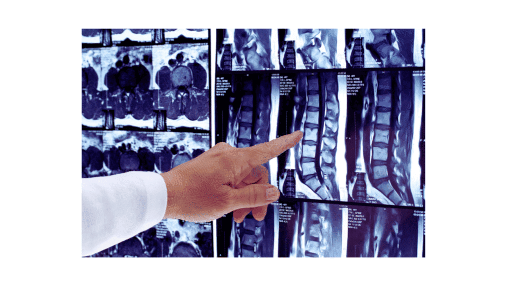 Mri scan lumbar spine pointing disc issue