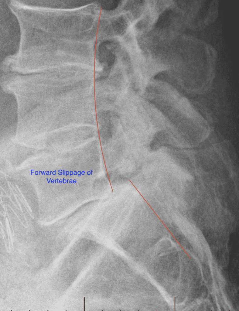 Side x ray showing spondylolisthesis lumbar vertebra