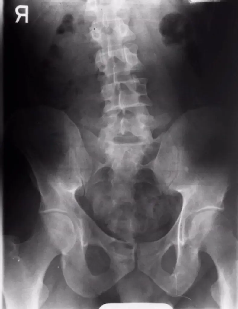 Xray of lumbar spine and pelvis