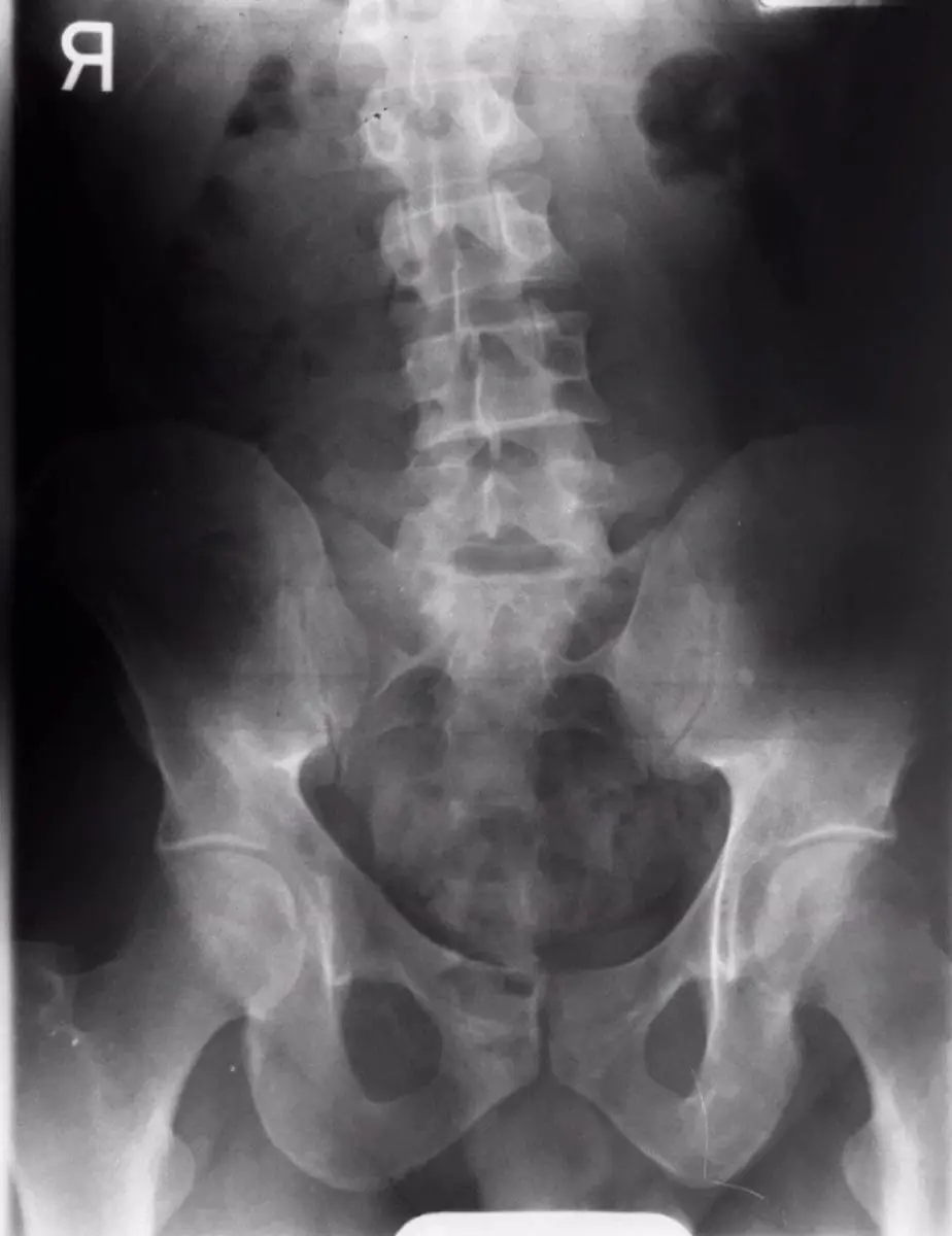 Xray of lumbar spine and pelvis