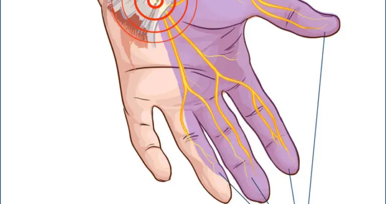 image showing the distribution of pins and needles and numbness hands when someone has carpal tunnel syndrome