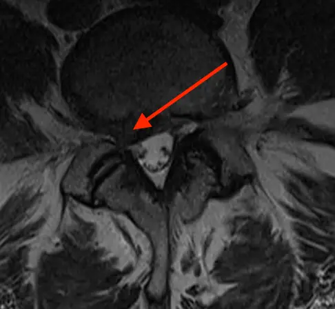 axial lumbar mri section with a red arrow pointing to a poterolateral disc protrusion