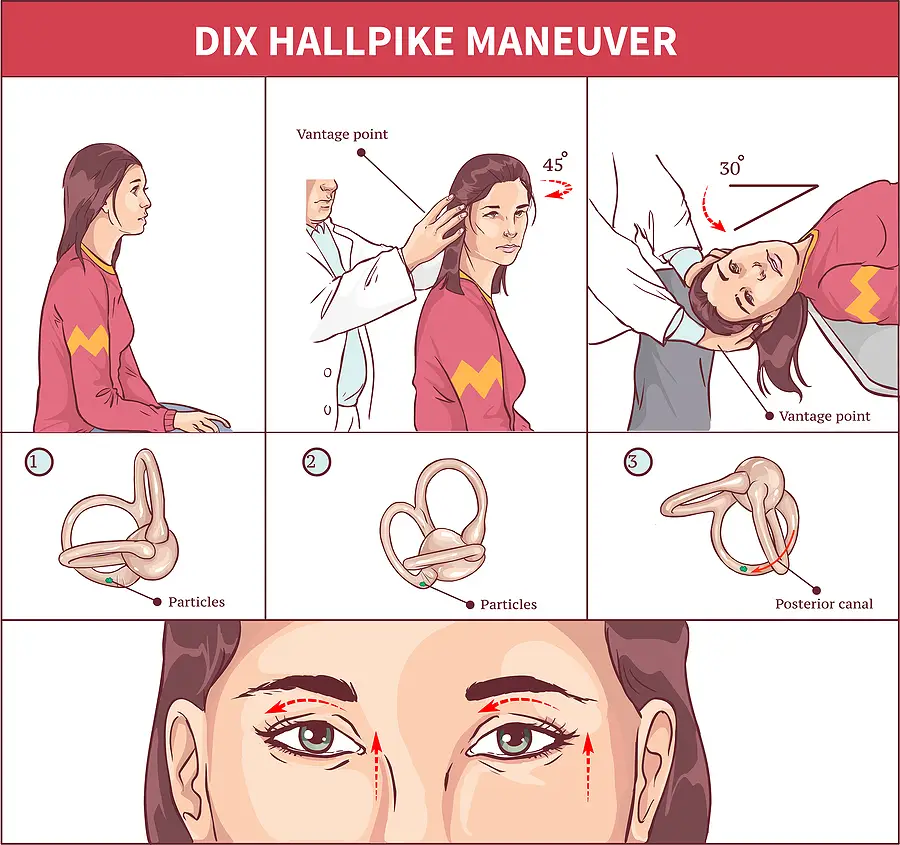 the dix hallpike maneuver used to diagnose BPPV in dizziness patients