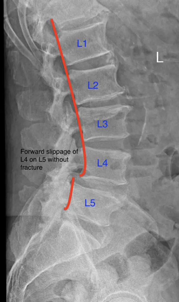 lateral lumbar spinal x-ray showing a forward slippage of the L4 vertebra on the L5 vertebra as indicated by a break in a red line drawn along the back of the vertebral bodies, also known as George's line