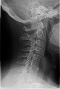 lateral x-ray of a neck