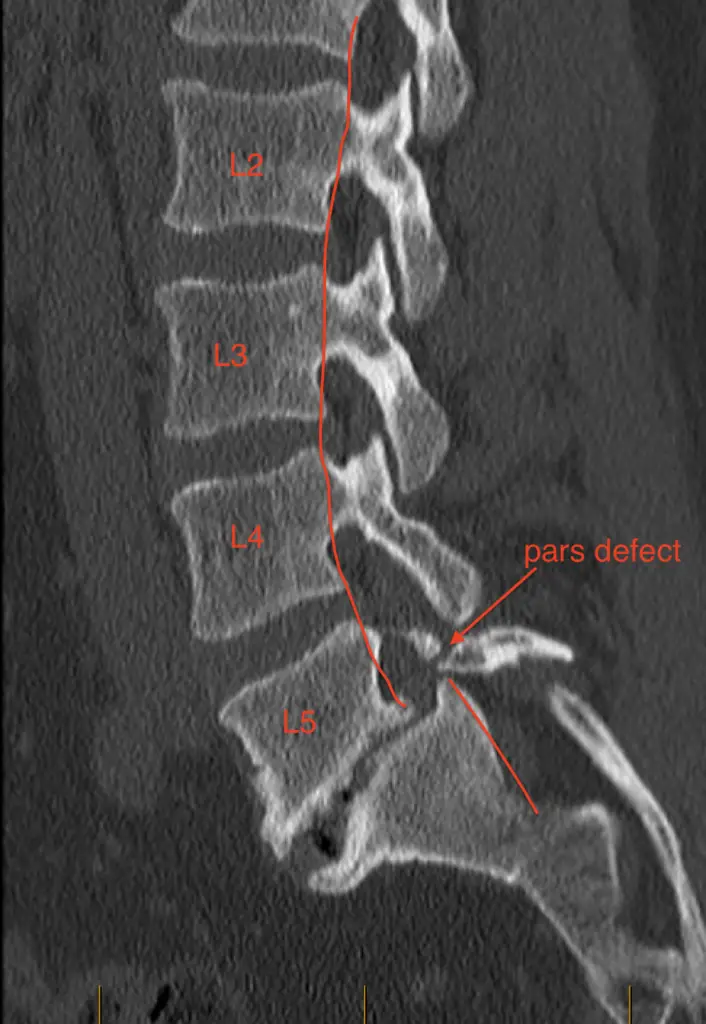 CT scan showing a side view of the lumbar spine and a pars defect at L5 and a forward slippage or spondylolisthesis of the L5 vertebrra