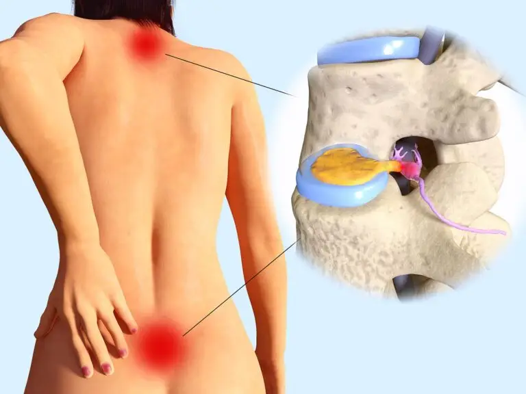 rear view of woman's torso holding back with left hand showing areas of inflammation in the upper and lower back indicated by red areas and also a side vew of 2 vertebrae showing a sisc protrusion