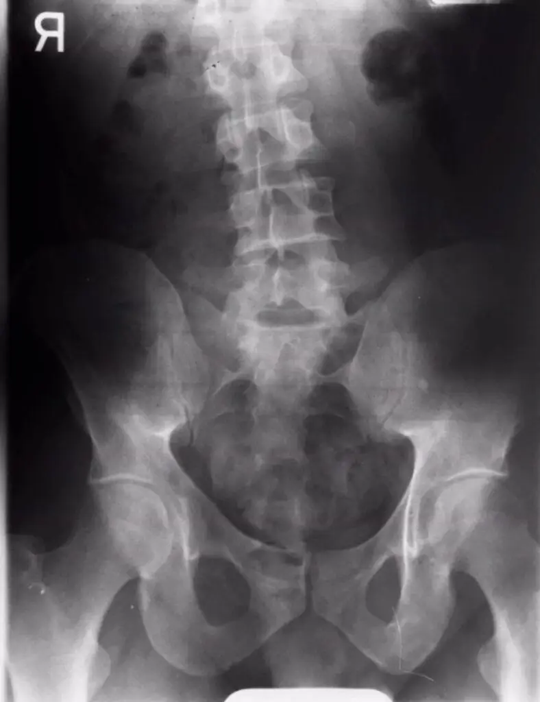 an x-ray of a lumbar spine in an antalgic posture